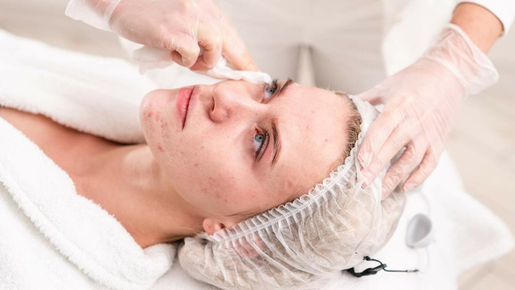Prescription Acne Treatment Online