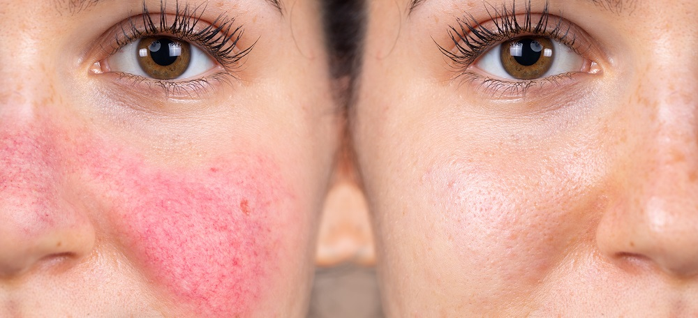 Rosacea or Acne? How Virtual Care Finds the Difference