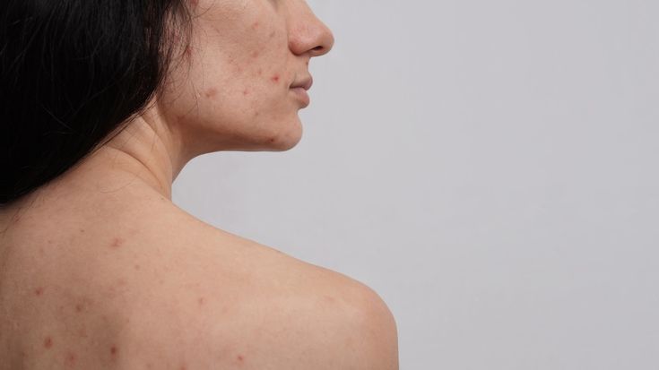 Treating Chest and Back Acne: Your Complete Guide