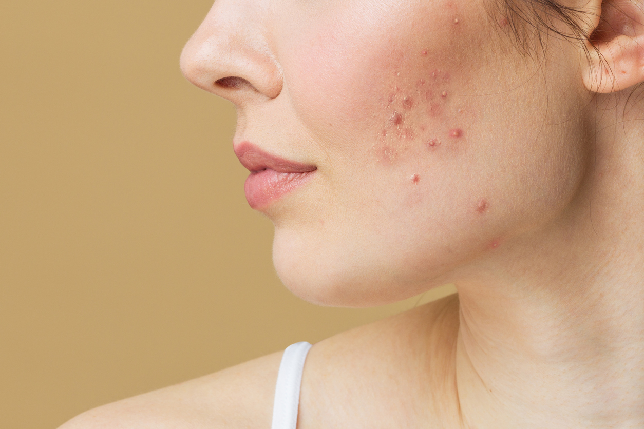 Hormonal Acne Diagnosis and Treatment Online