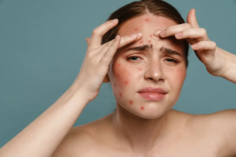 Acne Treatment