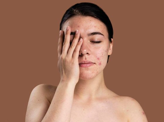 Person with facial redness from rosacea during a telehealth visit