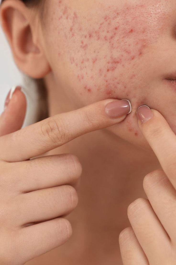 Clear Acne With Online Dermatology