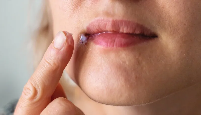Person starting antiviral cold sore treatment after a telehealth visit