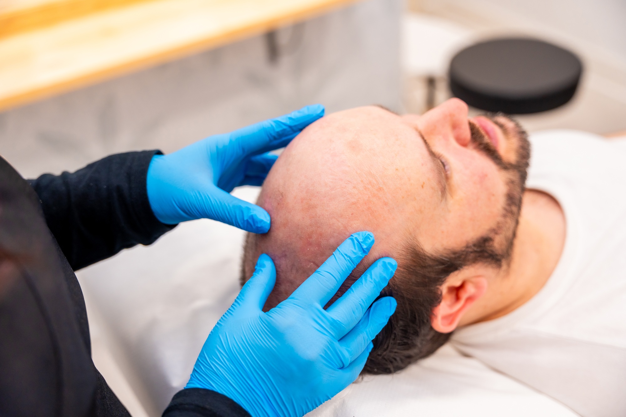 Navigating Hair Loss: Effective Treatments and What You Need to Know