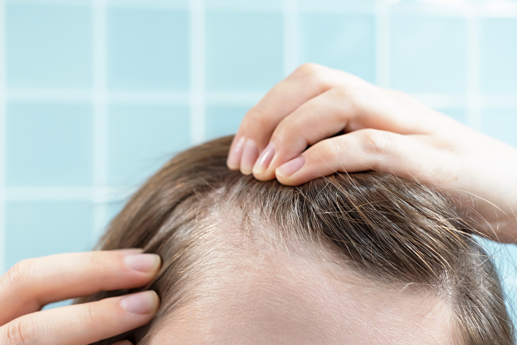 Hormones and Hair Loss: How to Identify and Treat Hormonal Imbalances