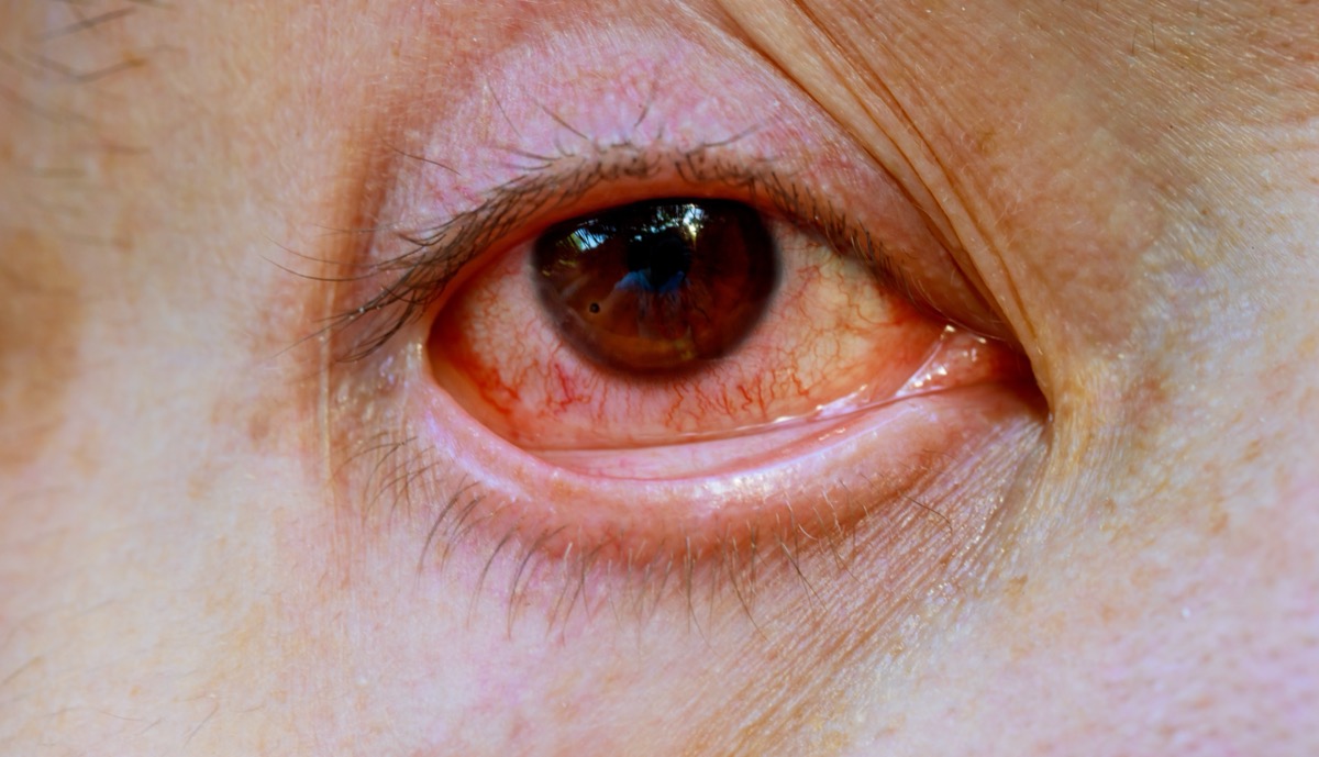Person with eye redness during a pink eye telehealth evaluation