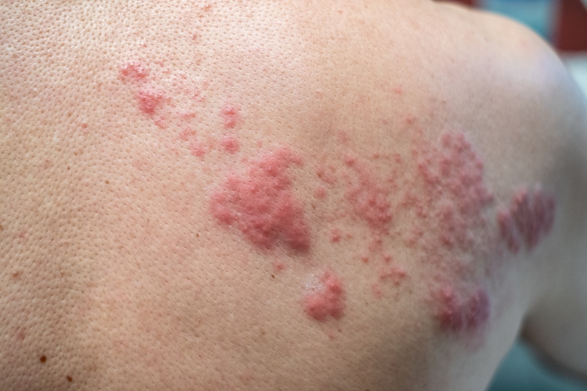 Person with a shingles rash during a telehealth evaluation