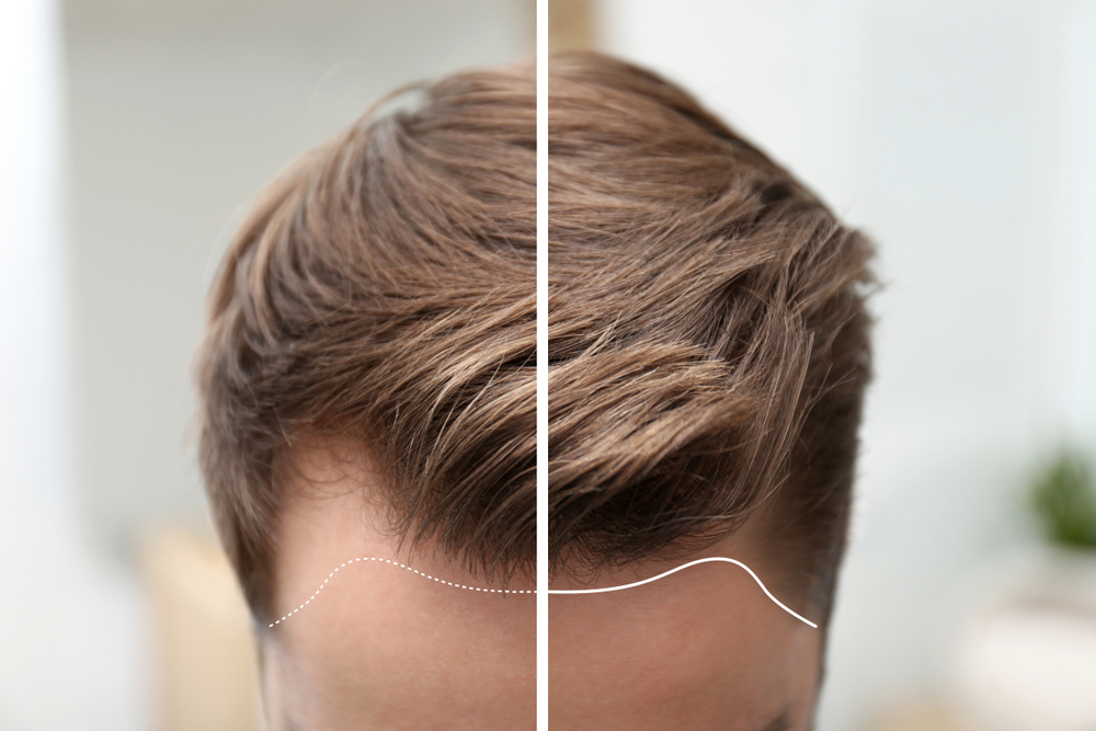 Navigating the Path to Hair Restoration: A Comprehensive Guide by OMNIA TeleHEALTH