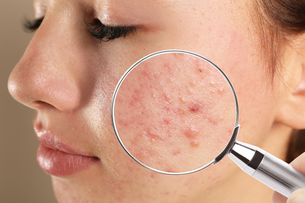 Real Stories: Triumphs Over Acne with Tailored Treatments
