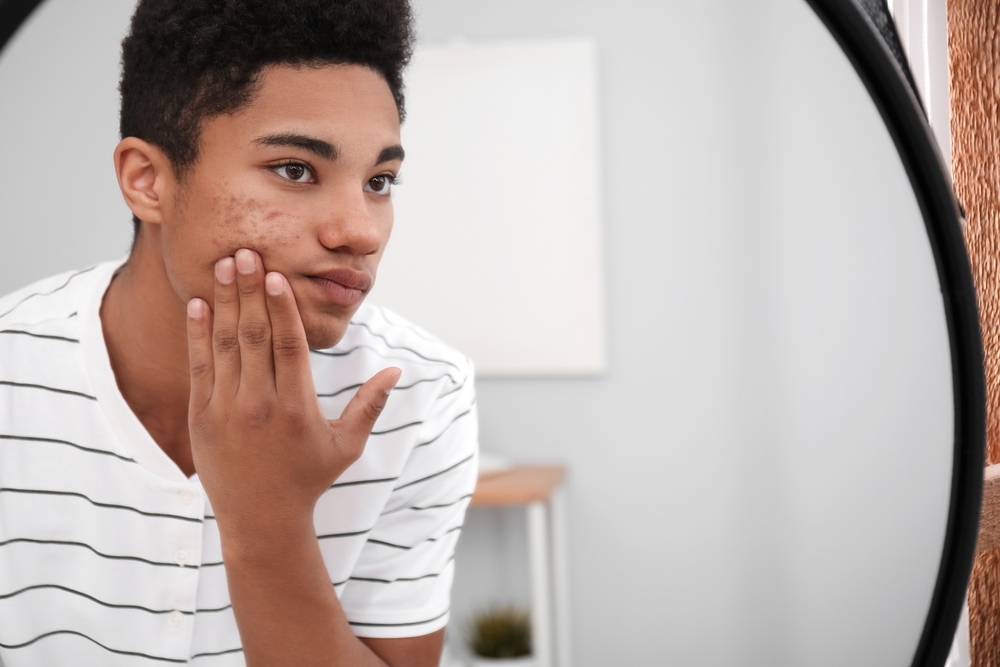 From Teen Years to Adulthood: Understanding the Lifecycle of Acne