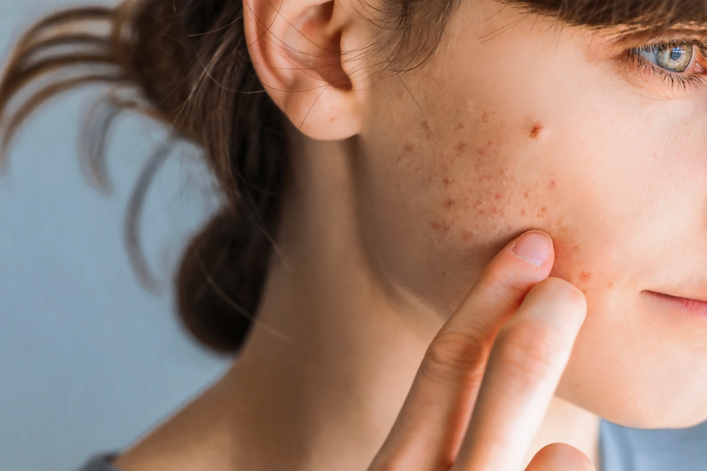 Acne treatment consultation