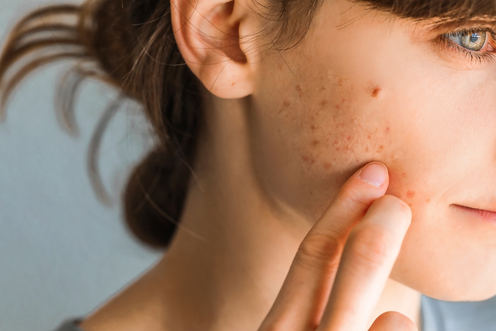 Unveiling the Environmental Impact of Acne Treatments: Insights from OMNIA TeleHEALTH