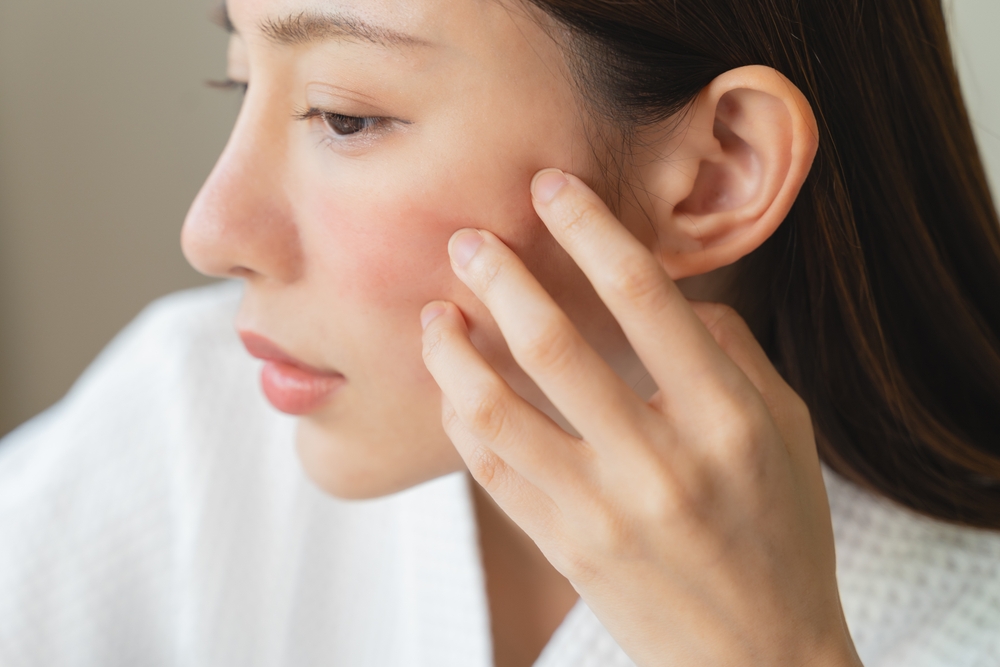 Understanding the Role of Genetics in Early-Onset Acne