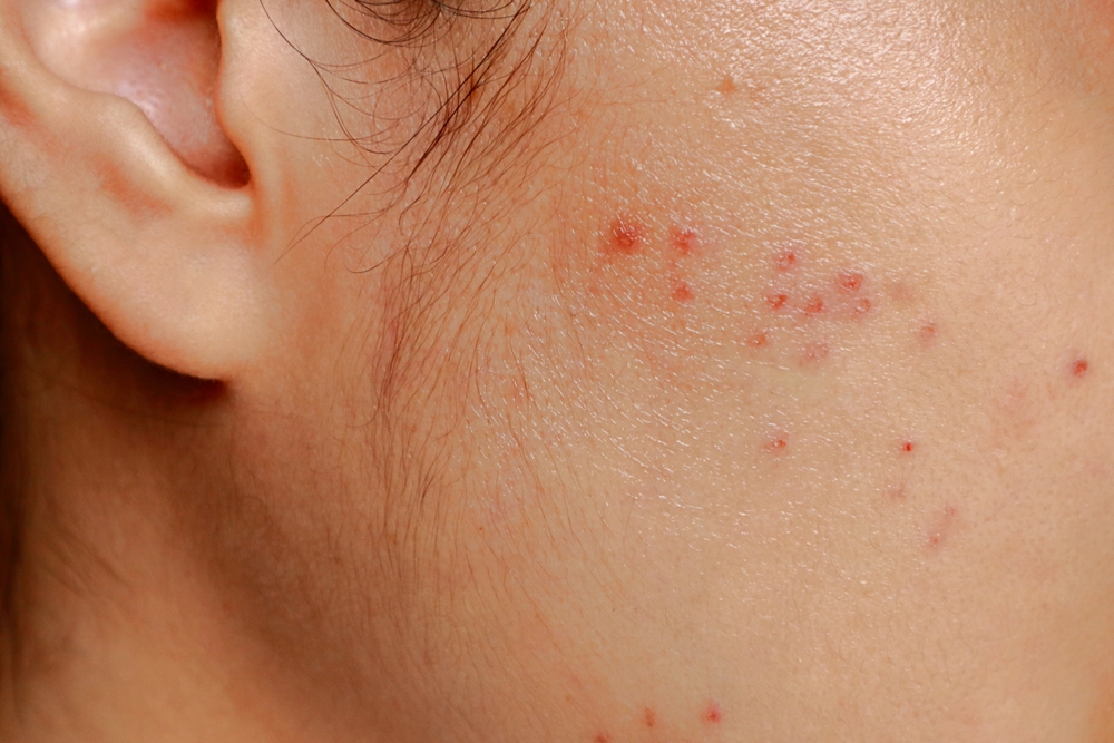 Caring for Your Skin: Post-Acne Scar Treatments and Solutions