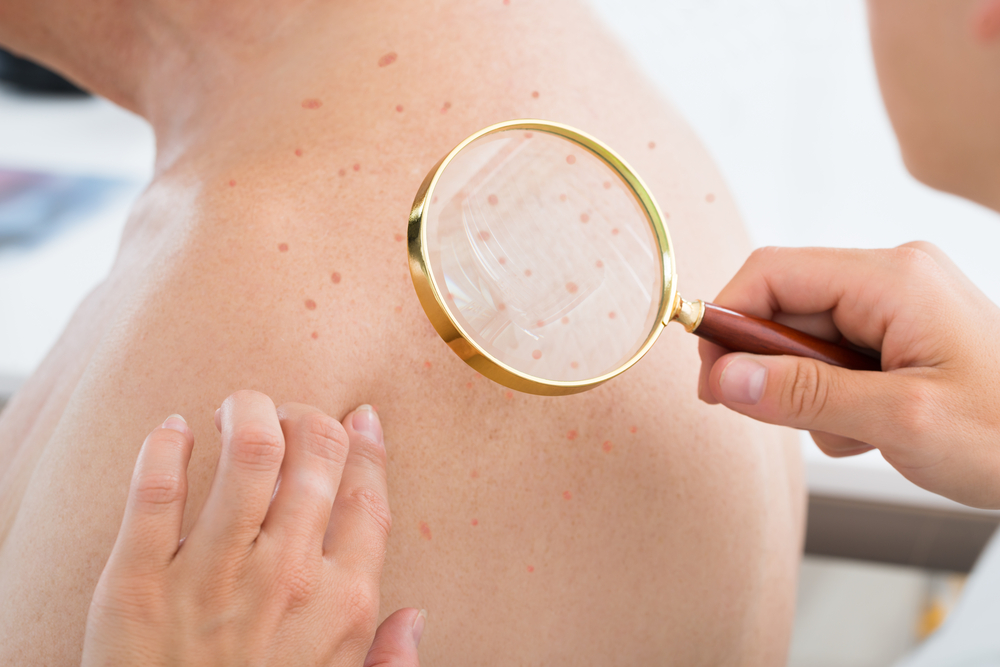Beyond the Face: Treating Acne on the Back and Chest