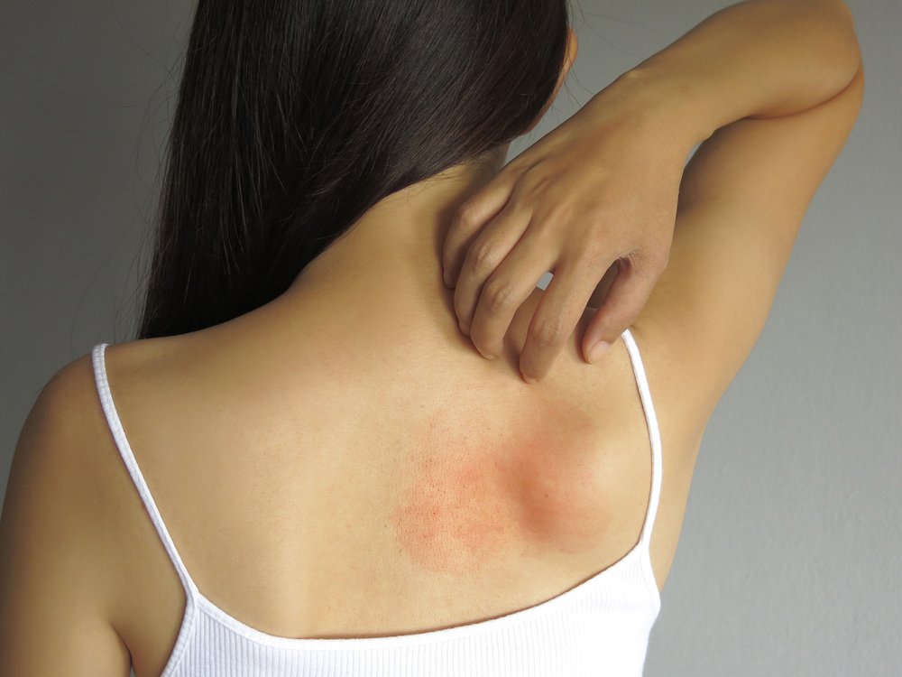 Person with a ringworm rash during a telehealth evaluation
