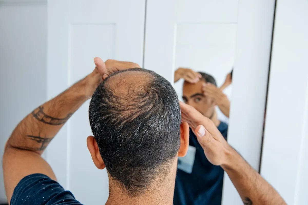 Start Hair Loss Treatment Early Online