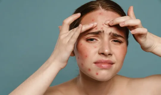 Acne Treatment
