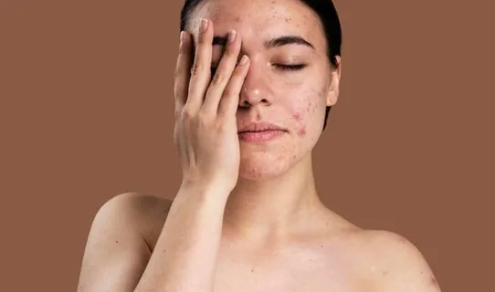 Rosacea
