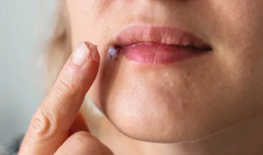 Cold Sores / Herpes