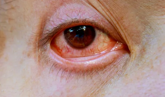 Pink Eye (Conjunctivitis)