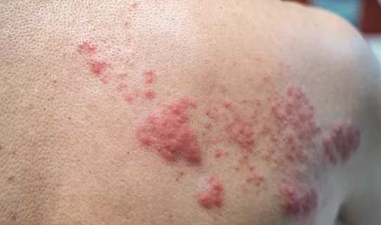 Shingles