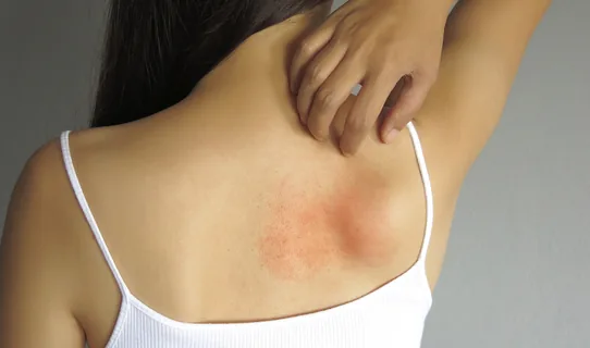 Ringworm